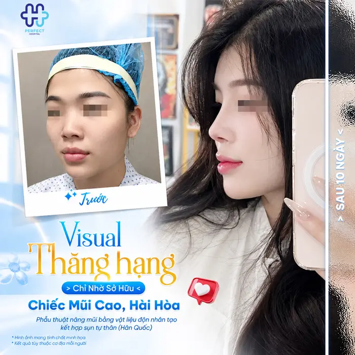 Mũi Tẹt Và Hếch Nên Nâng Kiểu Nào Để Đẹp Tự Nhiên, Hài Hòa?