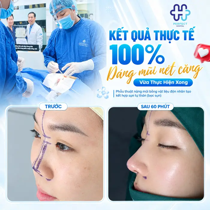 Mũi Tẹt Và Hếch Nên Nâng Kiểu Nào Để Đẹp Tự Nhiên, Hài Hòa?