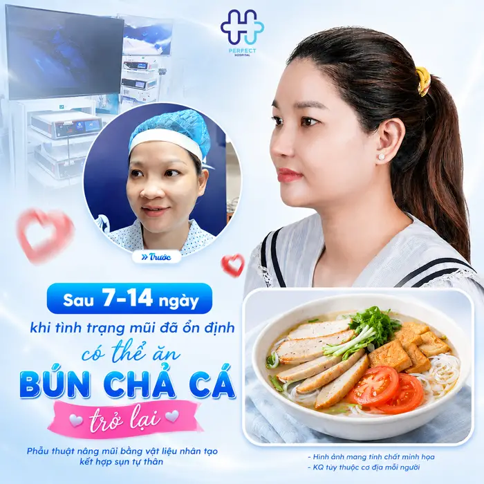 Nâng Mũi Ăn Bún Chả Cá Được Không? Bác Sĩ Giải Đáp Chi Tiết