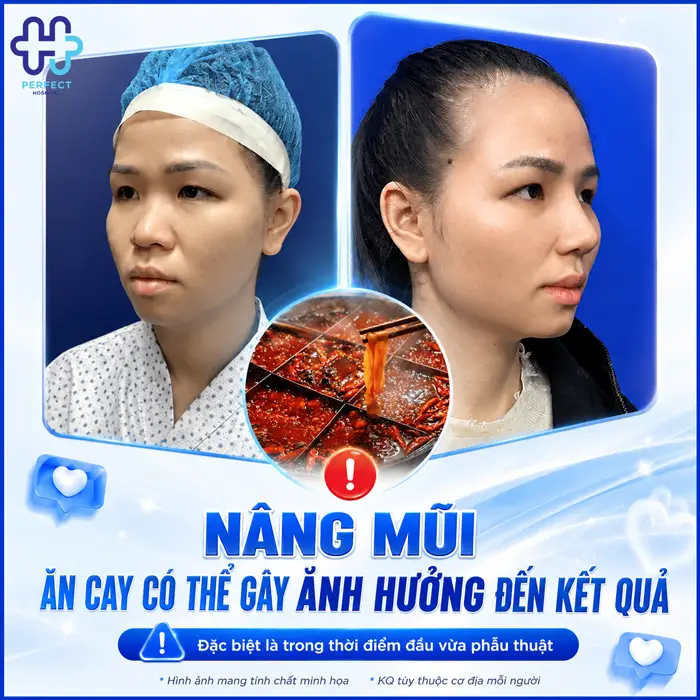 Nâng Mũi Ăn Cay Có Sao Không? Khi Nào Ăn Lại Được An Toàn