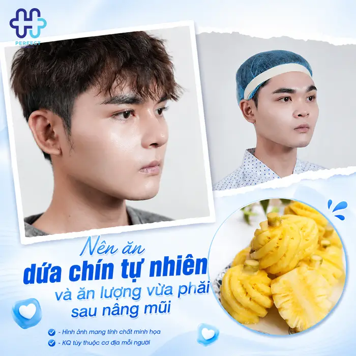 Nâng Mũi Ăn Dứa Được Không? Chuyên Gia Giải Đáp Chi Tiết