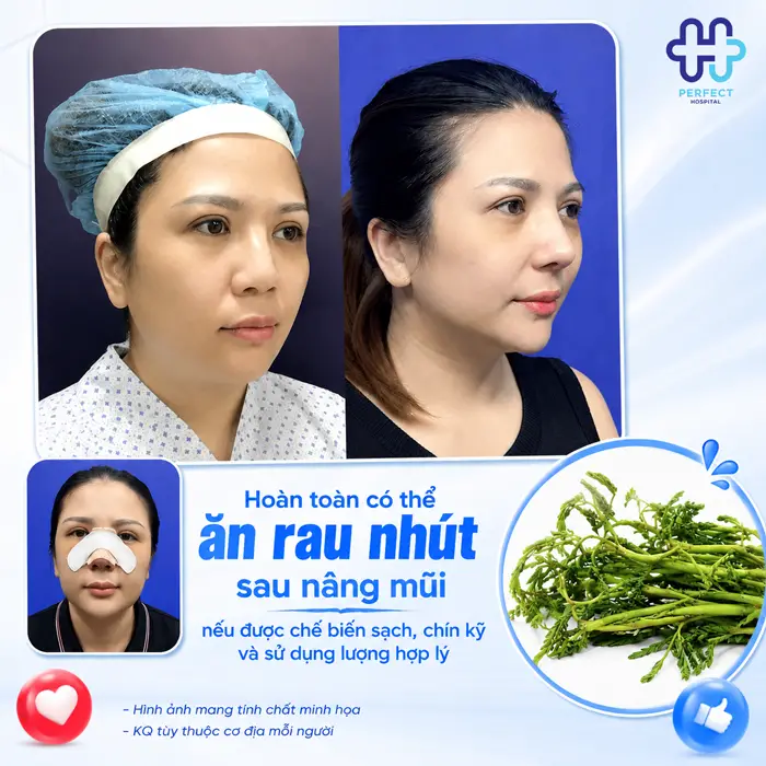 Nâng Mũi Ăn Rau Nhút Được Không? Cần Lưu Ý Gì Khi Ăn