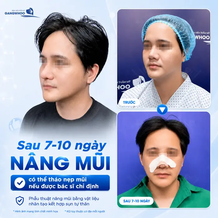 Nâng Mũi Mấy Ngày Tháo Nẹp? Thời Gian Tháo Nẹp Chuẩn Từ Bác Sĩ