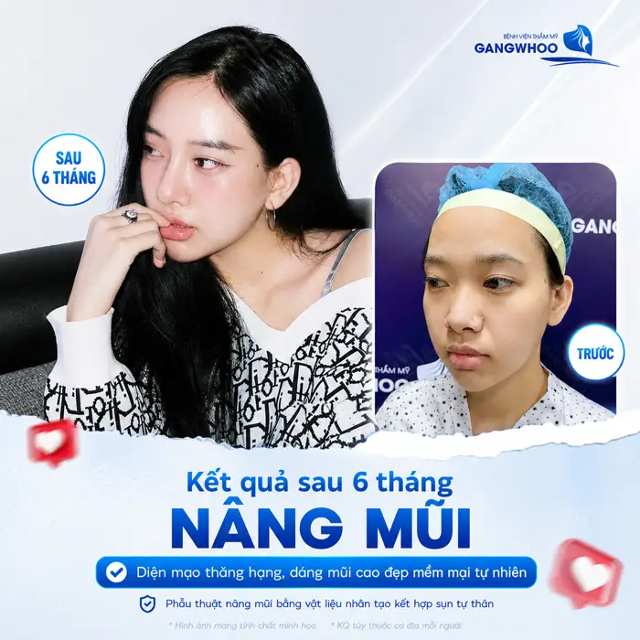 Nâng Mũi Mấy Ngày Tháo Nẹp? Thời Gian Tháo Nẹp Chuẩn Từ Bác Sĩ