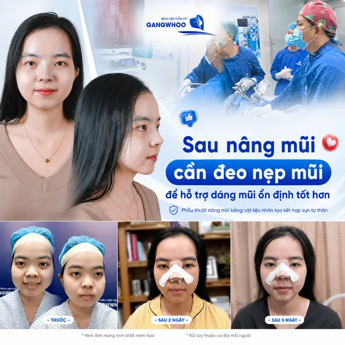 Nâng Mũi Mấy Ngày Tháo Nẹp? Thời Gian Tháo Nẹp Chuẩn Từ Bác Sĩ