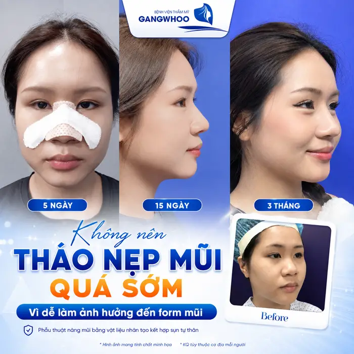 Nâng Mũi Mấy Ngày Tháo Nẹp? Thời Gian Tháo Nẹp Chuẩn Từ Bác Sĩ