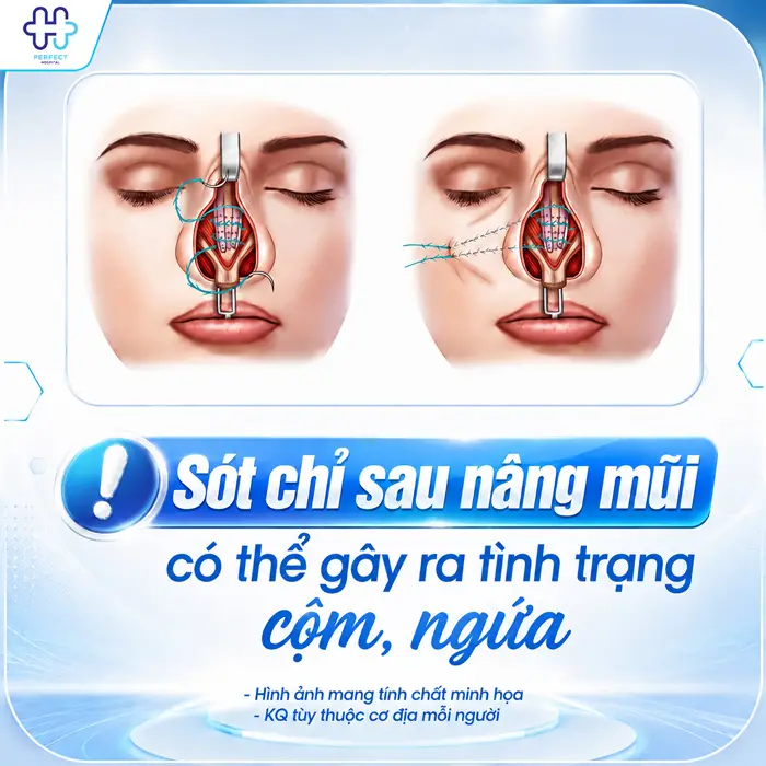 Nâng Mũi Bị Cắt Sót Chỉ Có Sao Không? Cách Xử Lý An Toàn