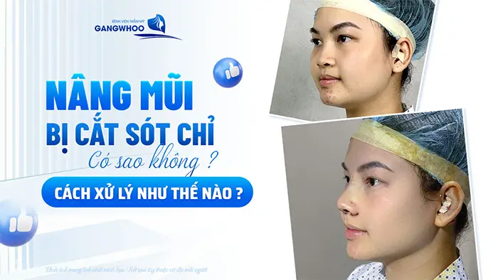 Nâng Mũi Bị Cắt Sót Chỉ Có Sao Không? Cách Xử Lý An Toàn