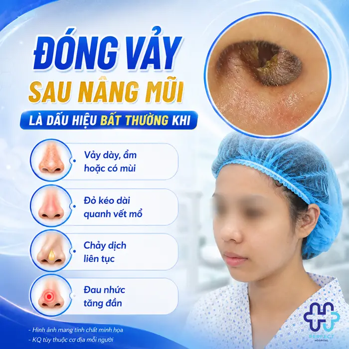 Nâng Mũi Bị Đóng Vảy Có Sao Không? Cách Chăm Sóc Đúng