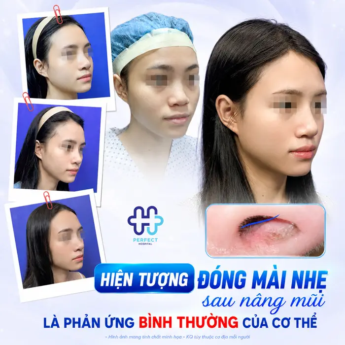Nâng Mũi Bị Đóng Vảy Có Sao Không? Cách Chăm Sóc Đúng