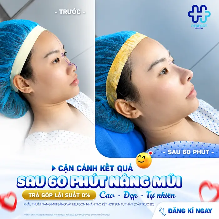 Nâng Mũi Cấu Trúc Và Bán Cấu Trúc Khác Nhau Ở Điểm Nào?