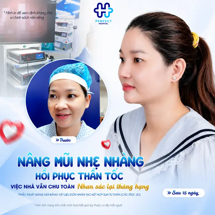 Nâng Mũi Cấu Trúc Và Bán Cấu Trúc Khác Nhau Ở Điểm Nào?