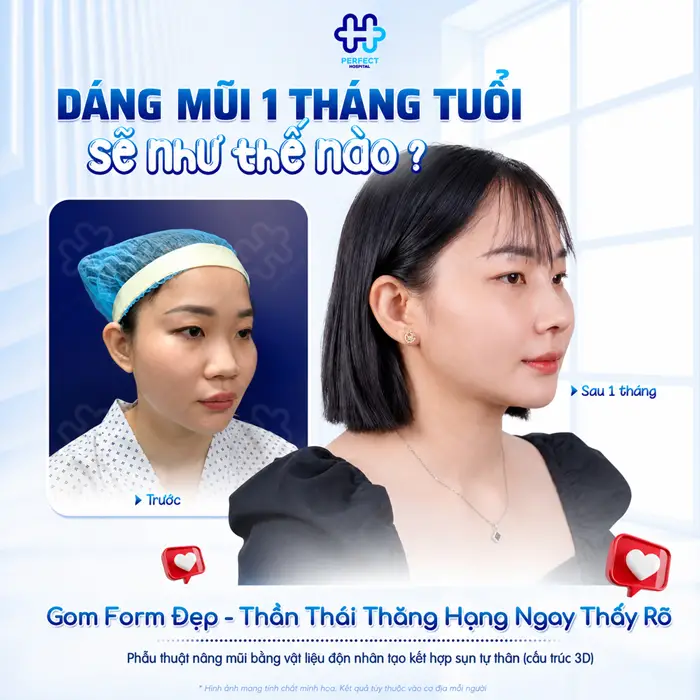 Nâng Mũi Cấu Trúc Và Bán Cấu Trúc Khác Nhau Ở Điểm Nào?