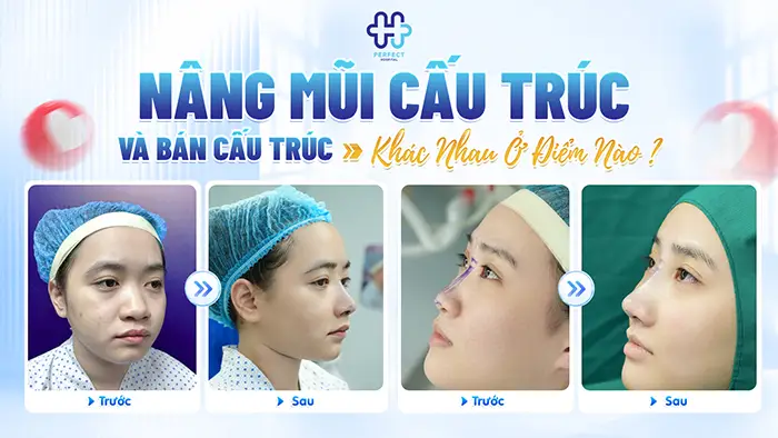 Nâng Mũi Cấu Trúc Và Bán Cấu Trúc Khác Nhau Ở Điểm Nào?