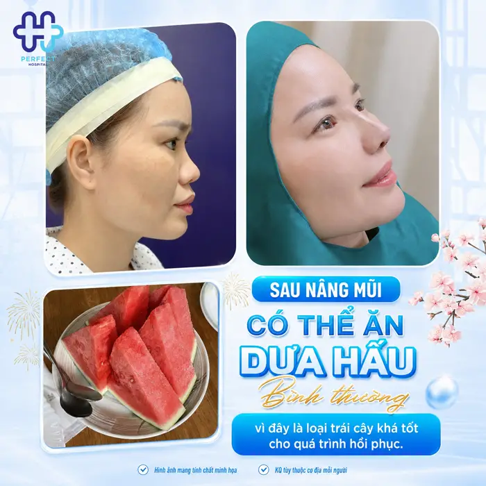 Nâng Mũi Ăn Dưa Hấu Được Không? Chuyên Gia Giải Đáp Chi Tiết