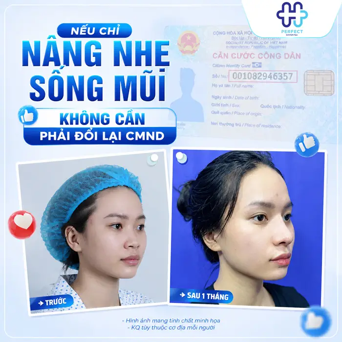 Nâng Mũi Có Cần Làm Lại CMND Không? Giải Đáp Mới Nhất