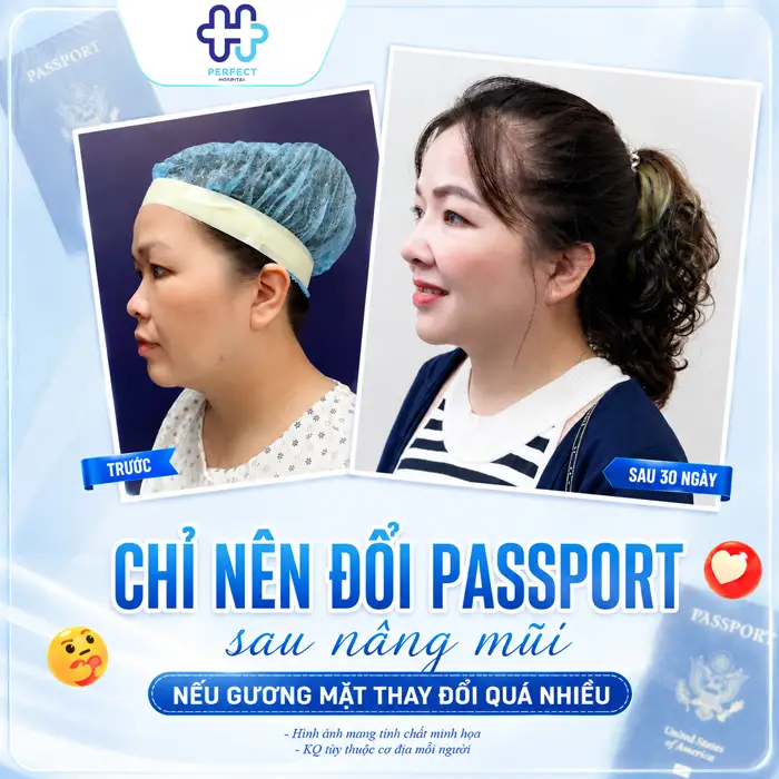 Nâng Mũi Có Cần Làm Lại Hộ Chiếu Không? Giải Đáp Chi Tiết