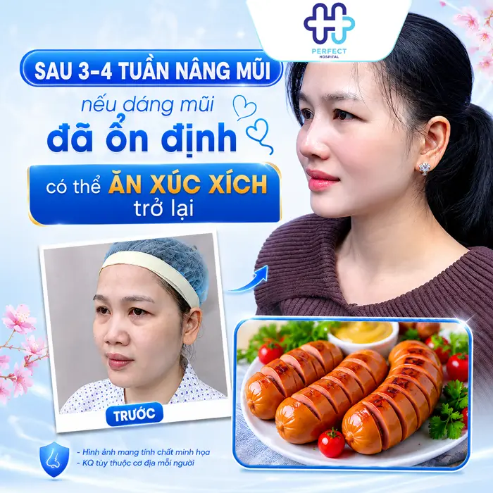 Nâng Mũi Có Được Ăn Xúc Xích Không? Chuyên Gia Giải Đáp