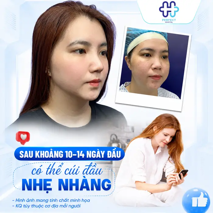 Nâng Mũi Có Được Cúi Đầu Không? Chuyên Gia Giải Đáp Chi Tiết