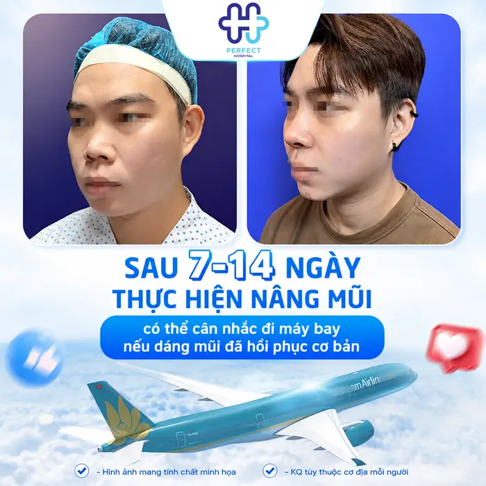 Nâng Mũi Có Được Đi Máy Bay Không? Giải Đáp Từ Chuyên Gia