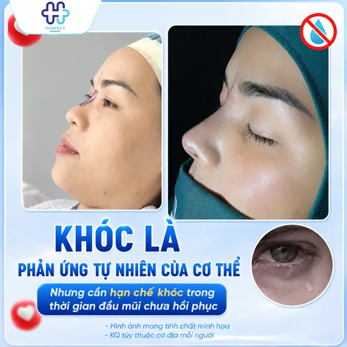 Nâng Mũi Có Được Khóc Không? Những Điều Cần Lưu Ý Sau Phẫu Thuật