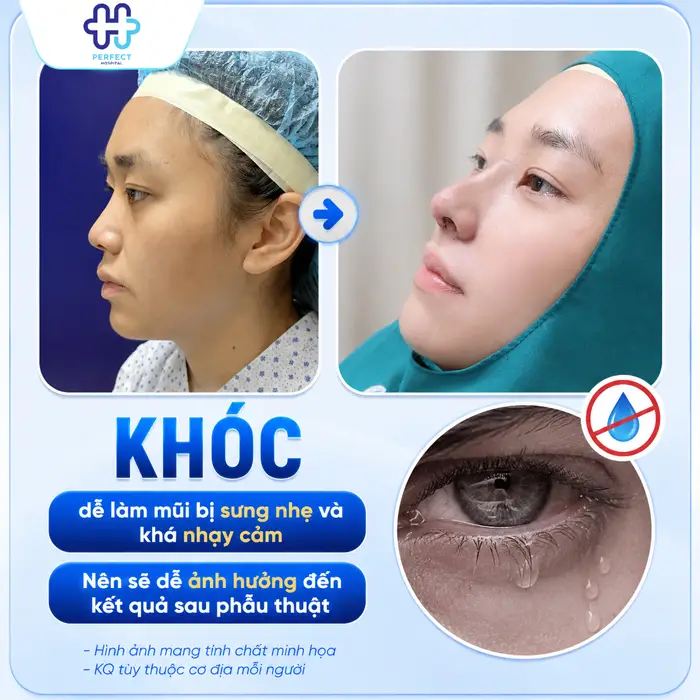 Nâng Mũi Có Được Khóc Không? Những Điều Cần Lưu Ý Sau Phẫu Thuật