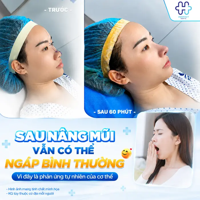 Nâng Mũi Có Được Ngáp Không? Những Điều Cần Lưu Ý Sau Phẫu Thuật