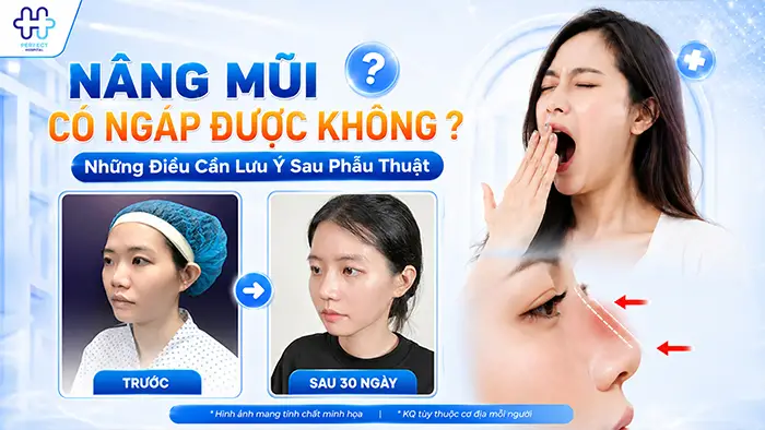 Nâng Mũi Có Được Ngáp Không? Những Điều Cần Lưu Ý Sau Phẫu Thuật