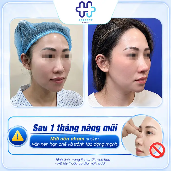 Nâng Mũi Có Véo Mũi Được Không? Những Điều Cần Biết Sau Khi Nâng