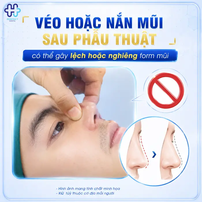 Nâng Mũi Có Véo Mũi Được Không? Những Điều Cần Biết Sau Khi Nâng