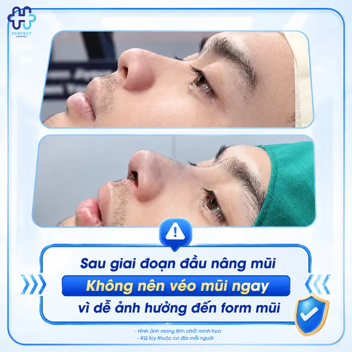 Nâng Mũi Có Véo Mũi Được Không? Những Điều Cần Biết Sau Khi Nâng