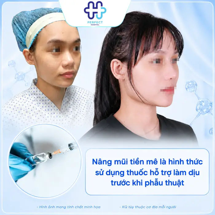 Nâng Mũi Gây Mê Hay Tiền Mê? Phương Pháp Nào Hiệu Quả