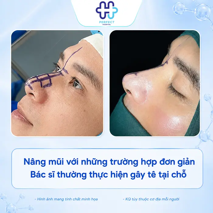 Nâng Mũi Gây Mê Hay Tiền Mê? Phương Pháp Nào Hiệu Quả