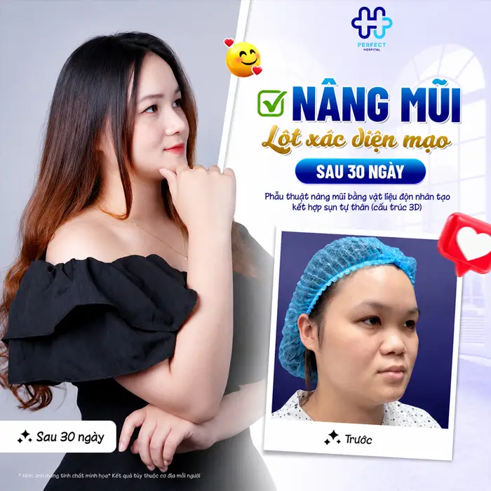 Nâng Mũi Hàn Quốc Giá Bao Nhiêu? Chi Phí Có Đắt Không?