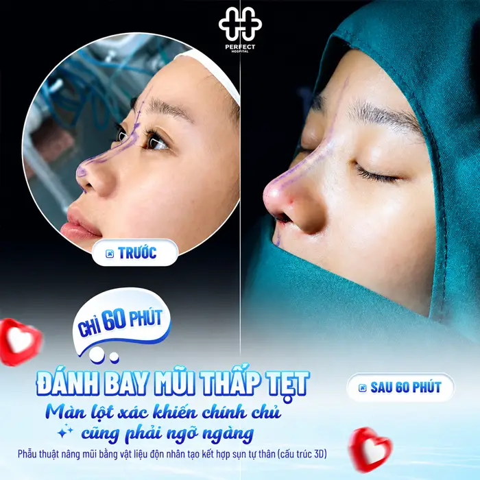 Nâng Mũi Hàn Quốc Giá Bao Nhiêu? Chi Phí Có Đắt Không?