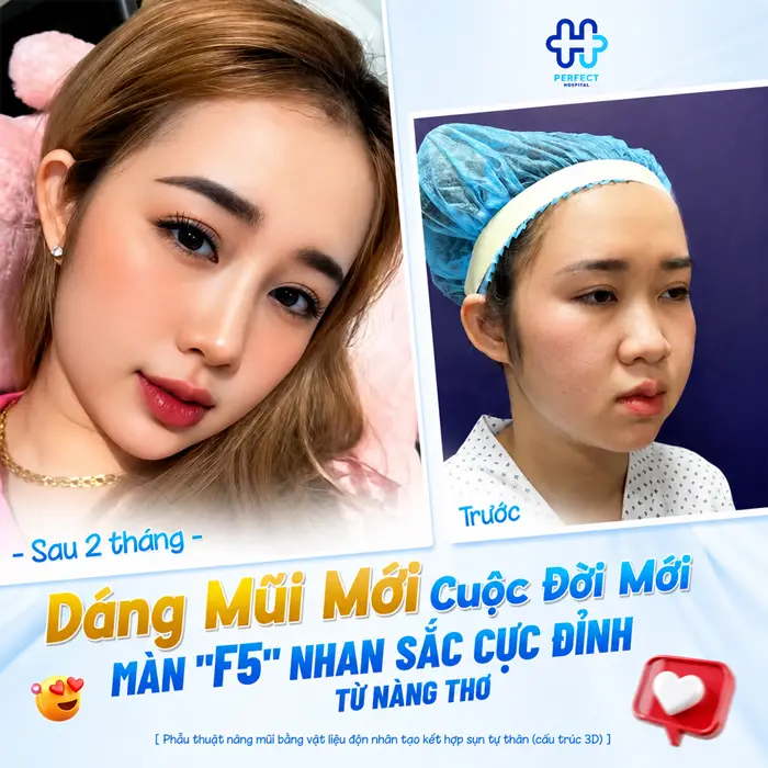 Nâng Mũi Hàn Quốc Giá Bao Nhiêu? Chi Phí Có Đắt Không?