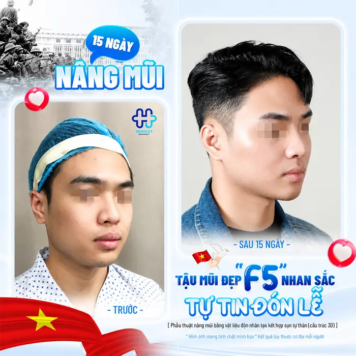 Nâng Mũi Nam Ở Đâu Đẹp? Tiêu Chí Chọn Địa Chỉ Uy Tín Cho Phái Mạnh