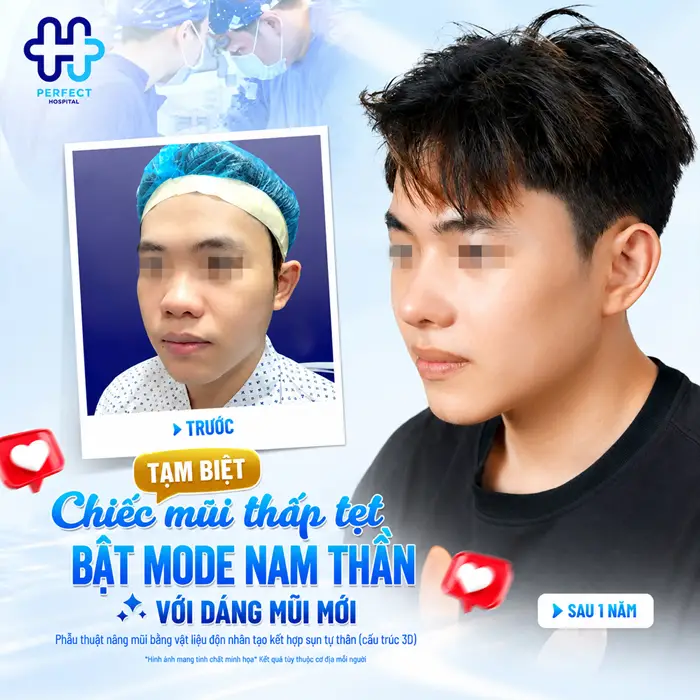 Nâng Mũi Nam Ở Đâu Đẹp? Tiêu Chí Chọn Địa Chỉ Uy Tín Cho Phái Mạnh