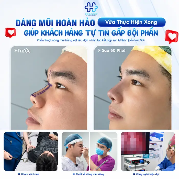 Nâng Mũi Nam Ở Đâu Đẹp? Tiêu Chí Chọn Địa Chỉ Uy Tín Cho Phái Mạnh