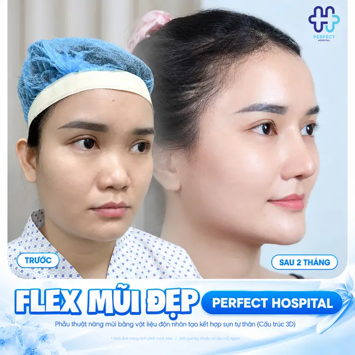Nâng Mũi S Line Bao Lâu Thì Đẹp? Thời Gian Lành Và Vào Form