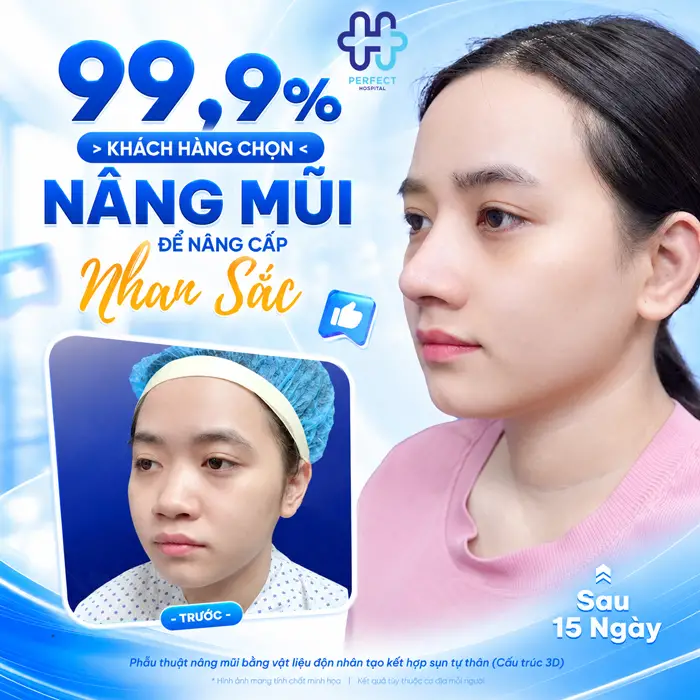 Nâng Mũi S Line Bao Lâu Thì Đẹp? Thời Gian Lành Và Vào Form