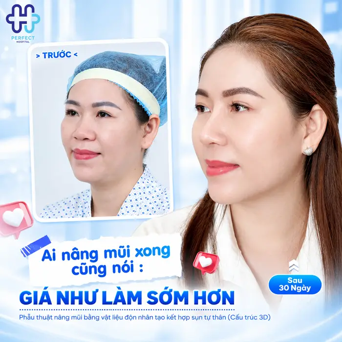 Nâng Mũi S Line Bao Lâu Thì Đẹp? Thời Gian Lành Và Vào Form