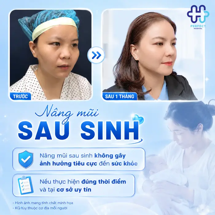 Sau Sinh Bao Lâu Thì Nâng Mũi Được? Thời Điểm An Toàn Nhất