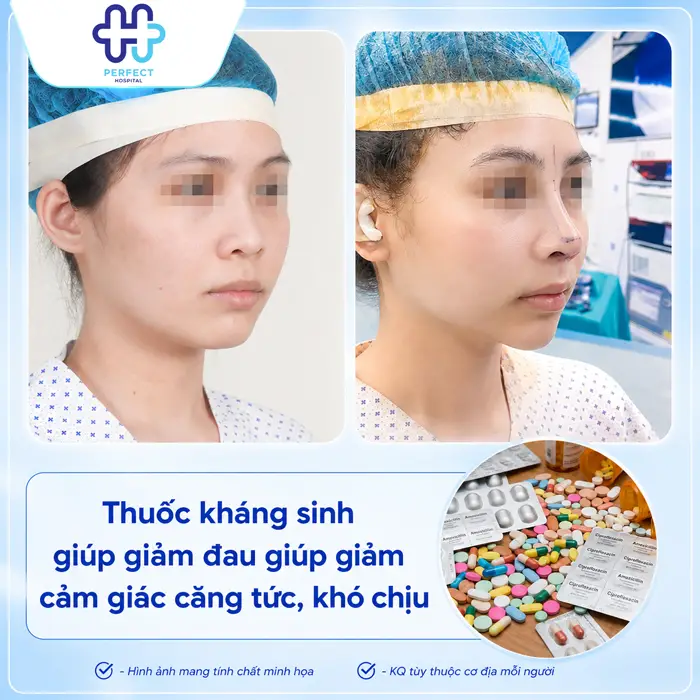 Nâng Mũi Uống Kháng Sinh Bao Lâu? Hướng Dẫn Chăm Sóc Đúng Cách