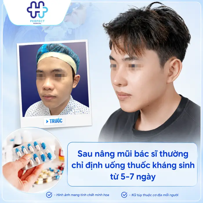 Nâng Mũi Uống Kháng Sinh Bao Lâu? Hướng Dẫn Chăm Sóc Đúng Cách