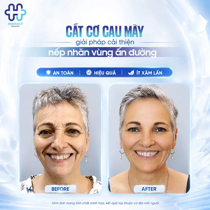 Cắt Cơ Cau Mày Giá Bao Nhiêu? Cập Nhật Chi Phí Mới 2026