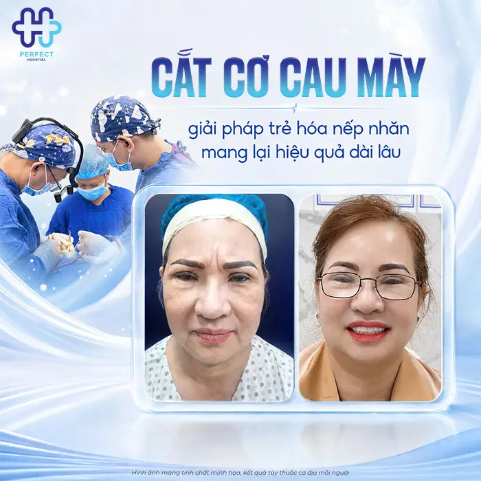 Cắt Cơ Cau Mày Giá Bao Nhiêu? Cập Nhật Chi Phí Mới 2026