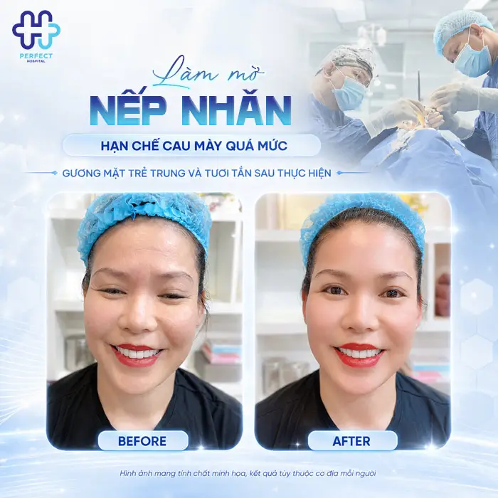 Cắt Cơ Cau Mày Giá Bao Nhiêu? Cập Nhật Chi Phí Mới 2026