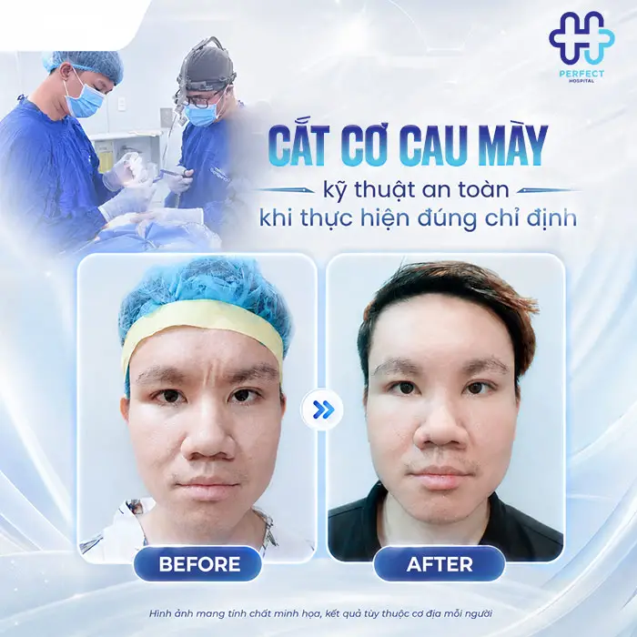 Cắt Cơ Cau Mày Giá Bao Nhiêu? Cập Nhật Chi Phí Mới 2026