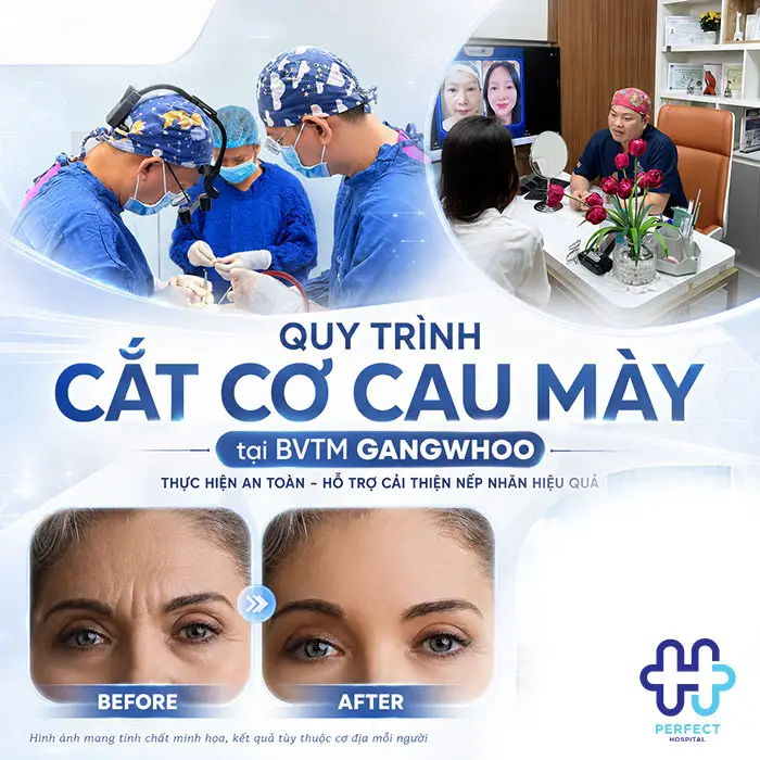 Cắt Cơ Cau Mày Giá Bao Nhiêu? Cập Nhật Chi Phí Mới 2026